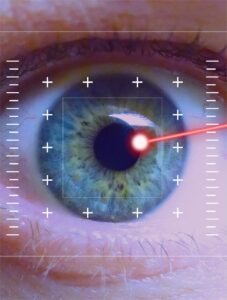 LASIK — Laser Eye Surgery: Procedure, Benefits, and Recovery